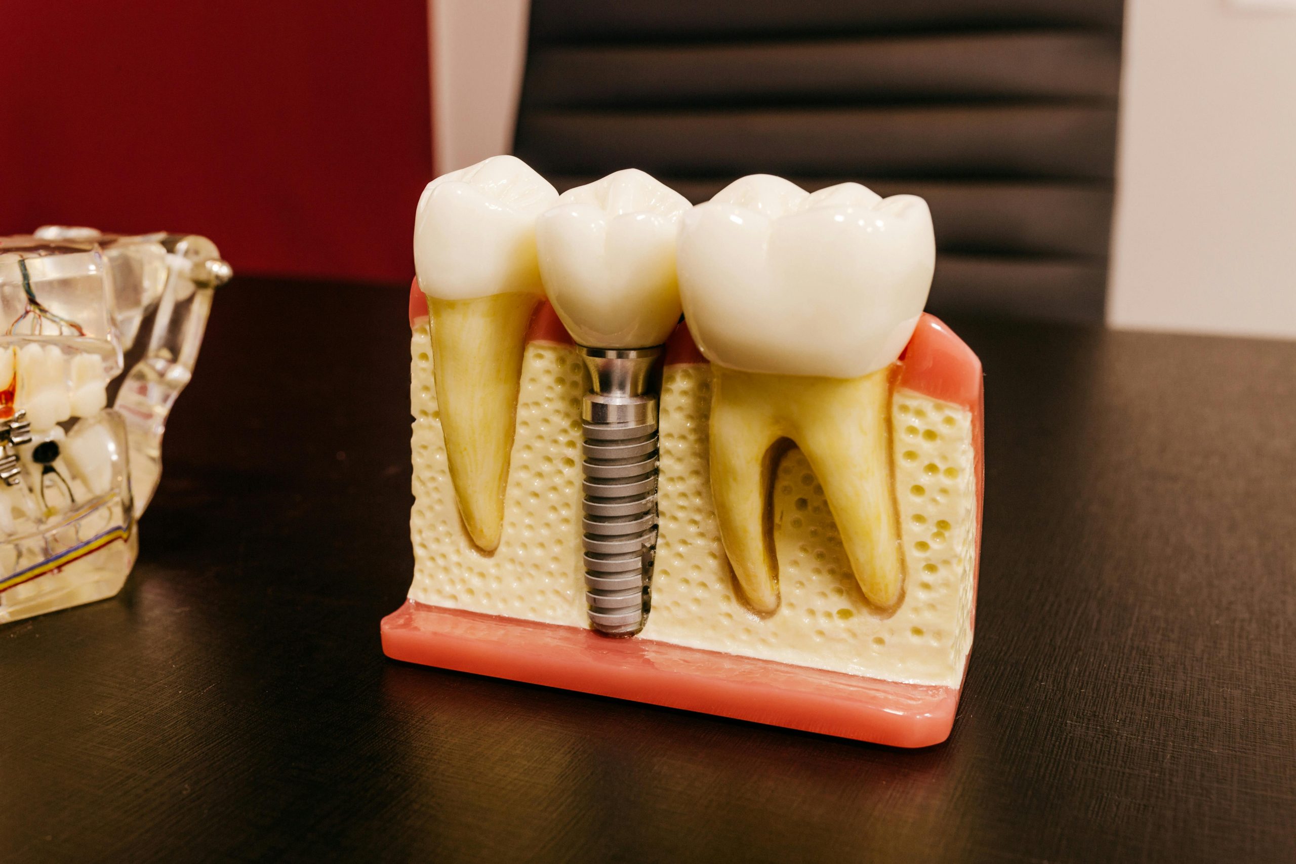 dental implants marketng